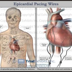 Your patients epicardial wires were pulled 30 minutes ago